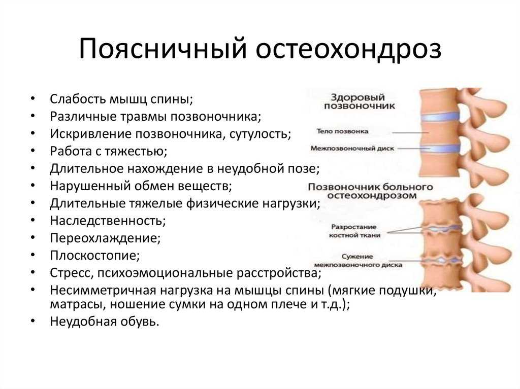Остеопороз позвоночника – лечение, симптомы, питание