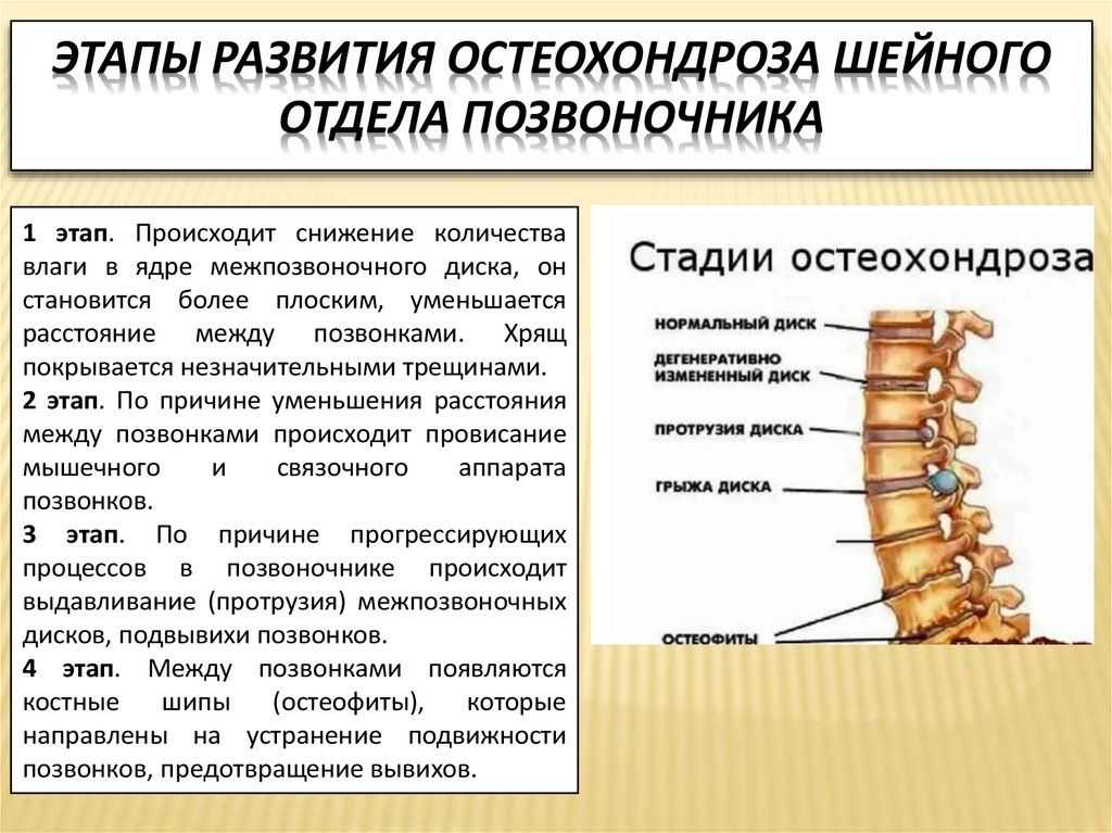 Виды, стадии и степени остеохондроза
